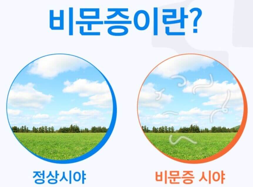 비문증 원인을 그림을 통해 설명