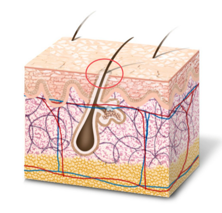 모공각화증의 증상