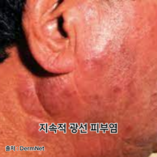 햇빛-알레르기-증상
