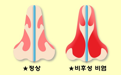 알레르기 비염 모습