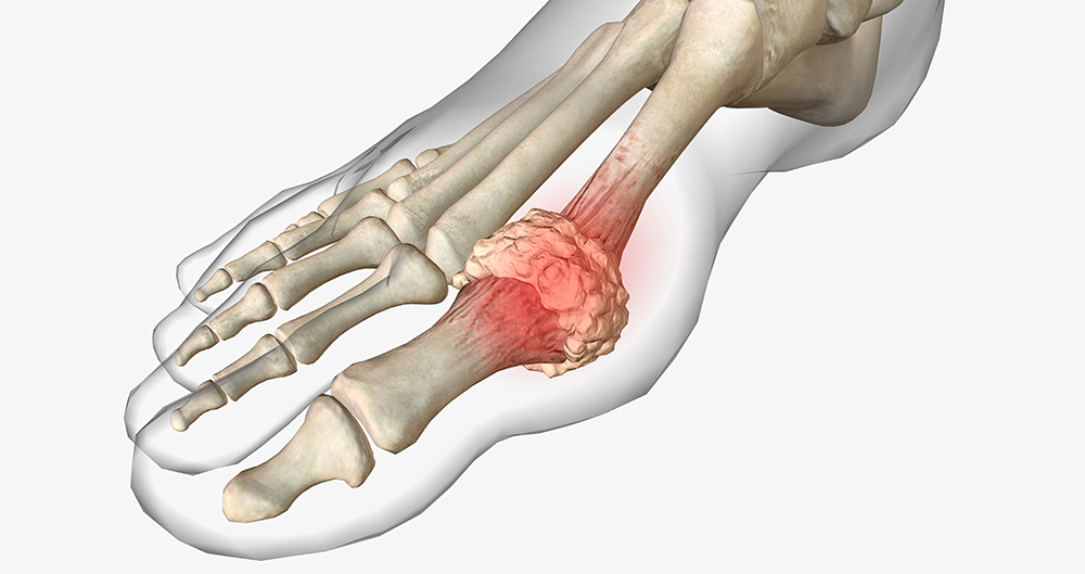 통풍에 해로운 음식