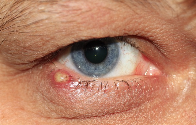 베체트병 진단부터 치료까지 관련 사진