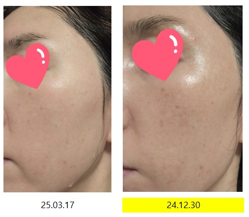 2025년 3월 과채 주스 먹은 후 오른쪽 얼굴 피부 변화 사진