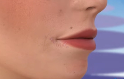 입술 수포 원인