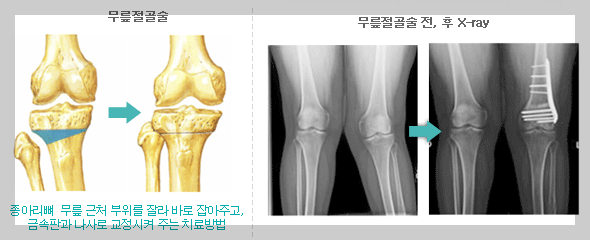 교정절골수술