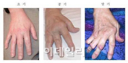 손가락 류마티스 관절염 주요 증상과 체크 리스트