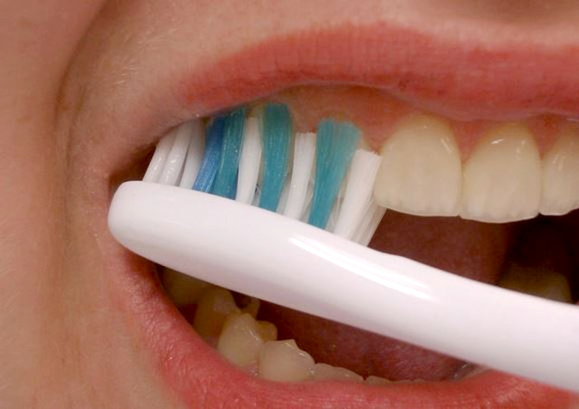 양치 치매,누렁니