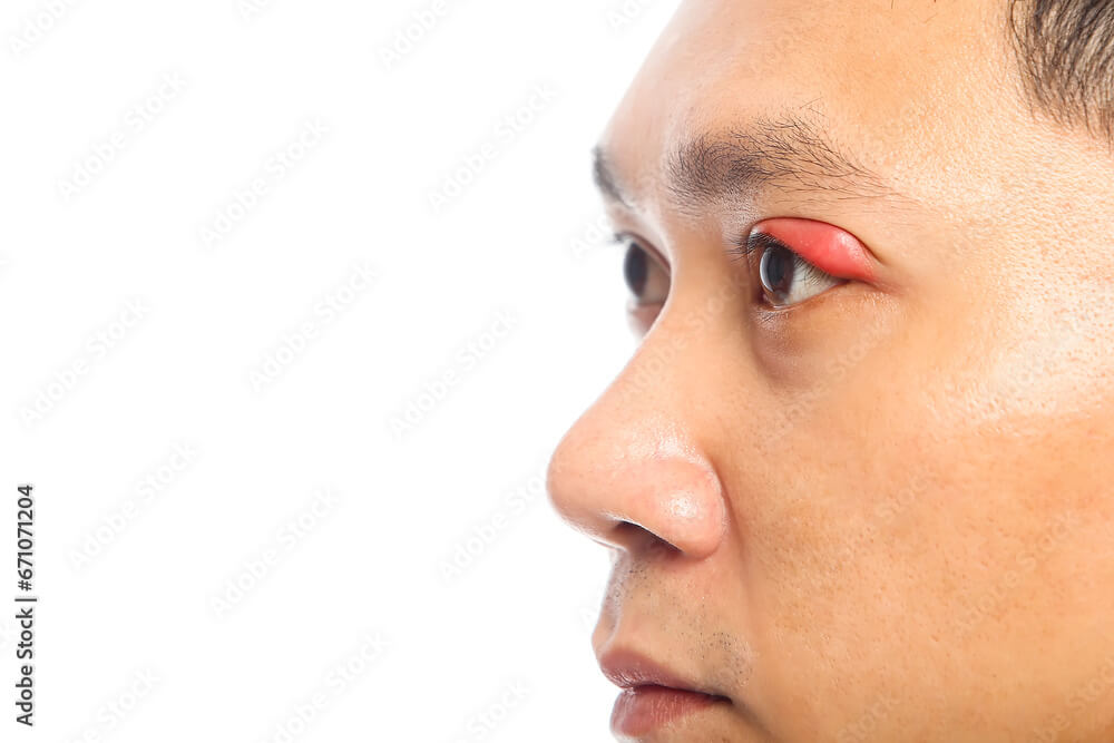 다래끼 원인 전염 증상 총정리