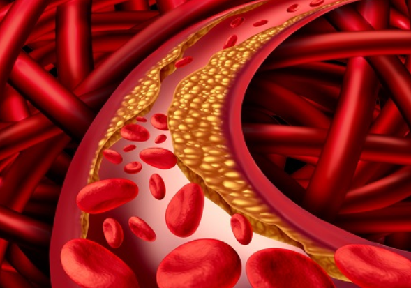 아티초크 콜레스테롤