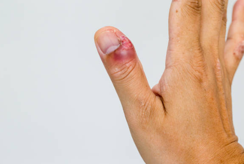 손 거스러미 염증