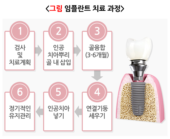 임플란트 의료보험적용 총정리