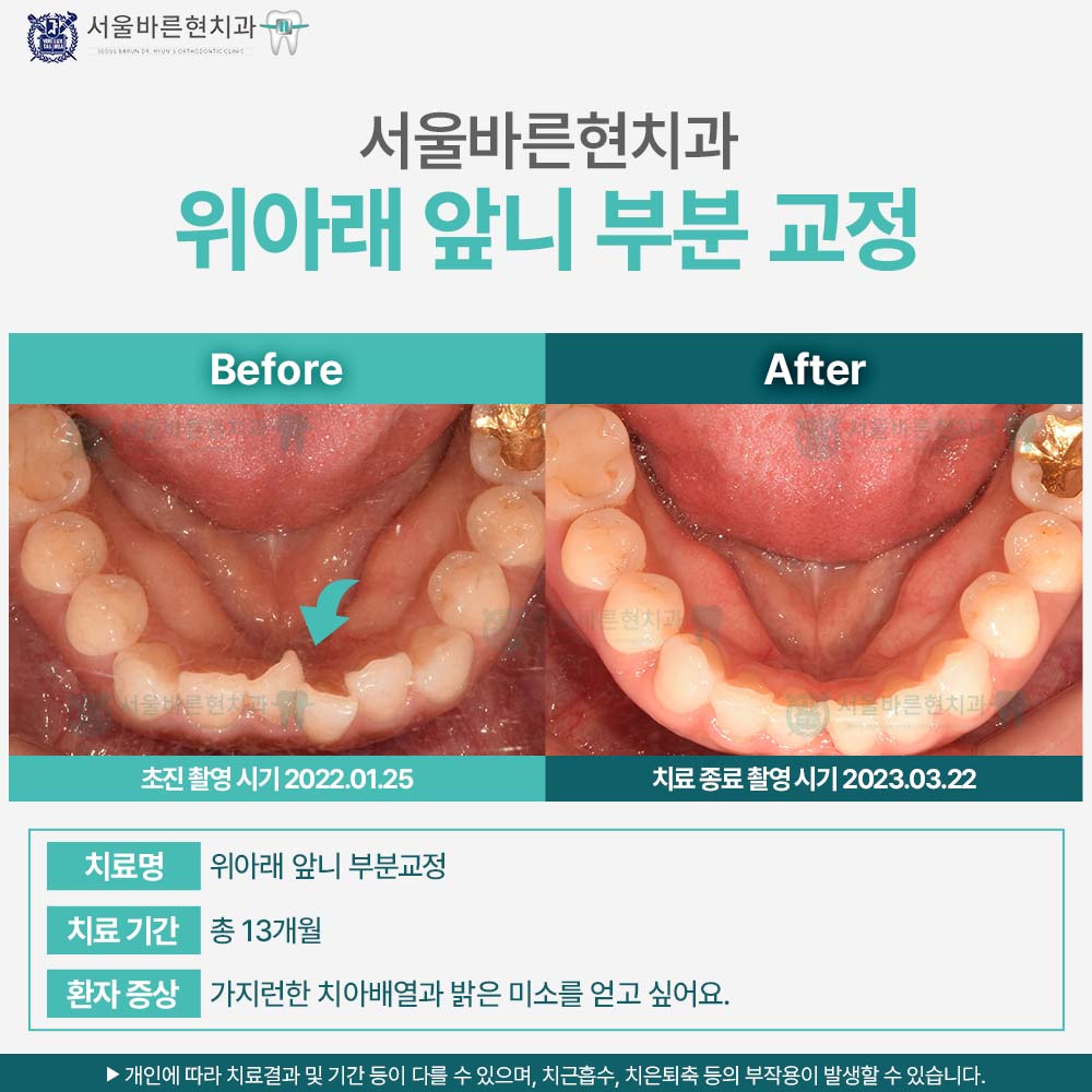 해운대치아교정
