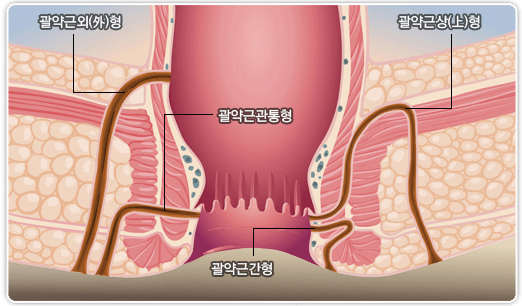 치루 개념