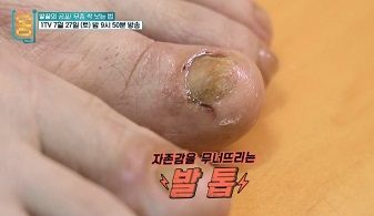 무좀
