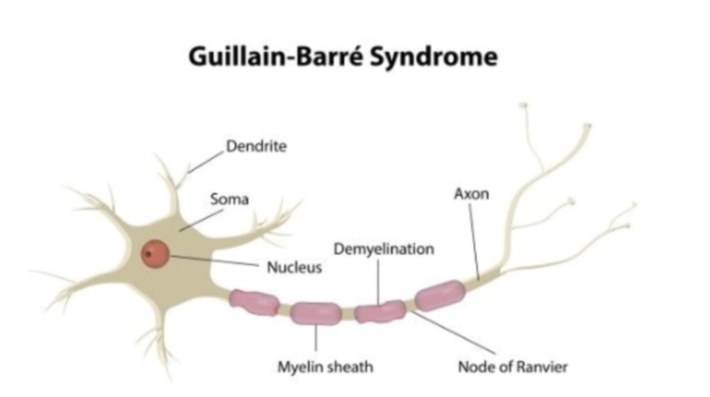 길랭 바레 증후군 기본정보