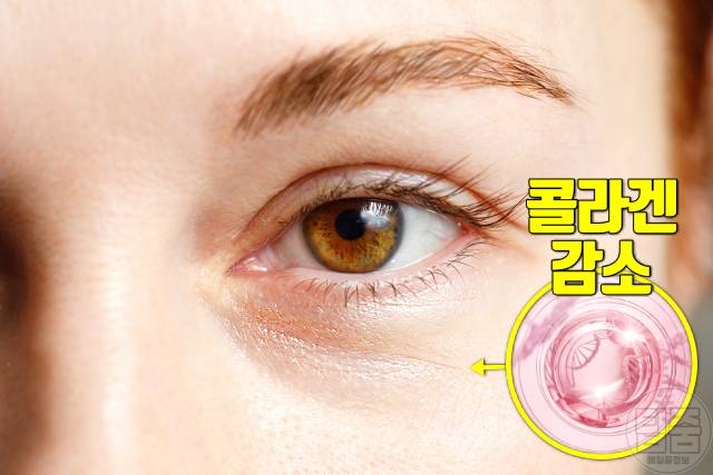 눈밑주름 제거 콜라겐 부족 보충