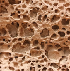 이석증 증상 후유증 원인 예방치료방법