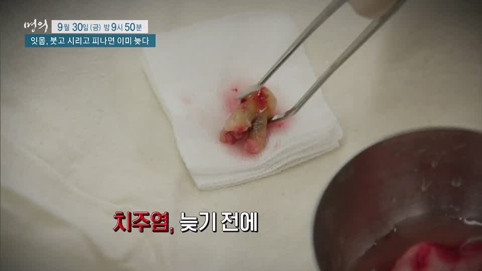 명의 붓고, 시리고, 피나면 이미 늦는 치주염 잇몸 질환 치주질환 치료, 예방 방법