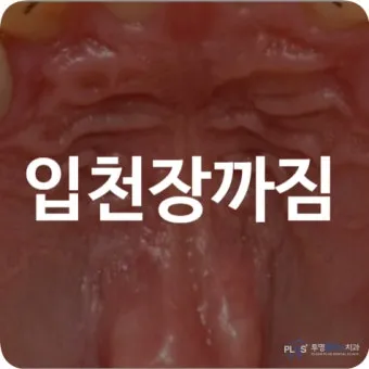 입천장 헐었을 때 면역력 저하 관련 증상과 영양 관리법_12
