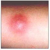 종기가 생기는 이유