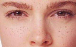 멜라논 크림의 장점과 단점