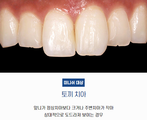 토끼 치아