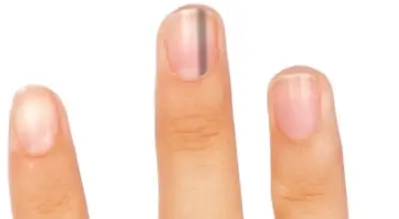 손톱에 검은 세로줄이 생기는 이유