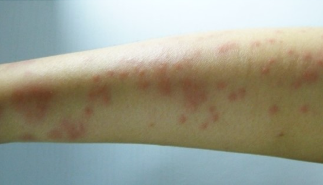 해파리 상처 흉터 없이 회복하는 법