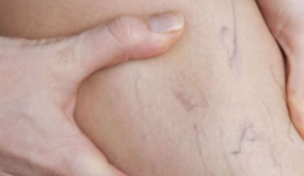 하지정맥류 초기증상과 예방법