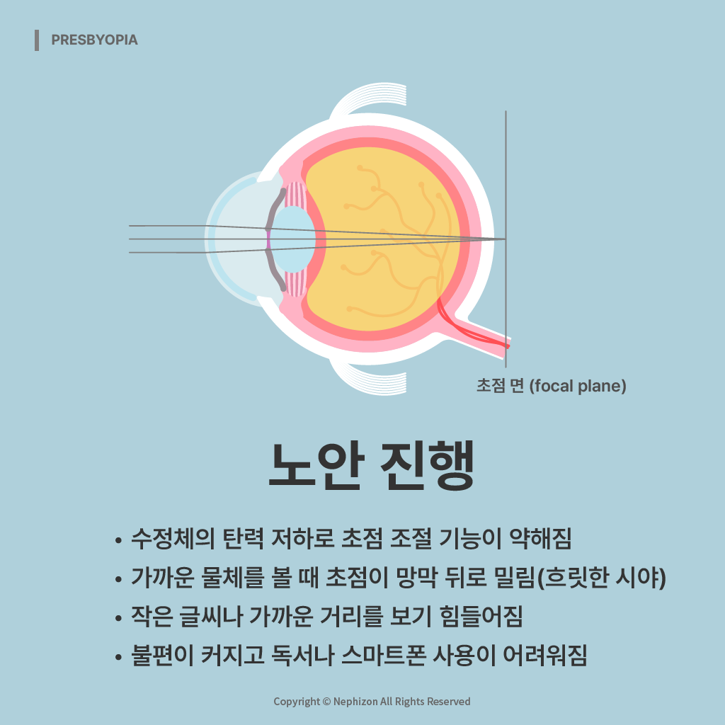 노안 진행