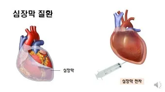 심장에 물이 차는 이유와 관련 질병_21