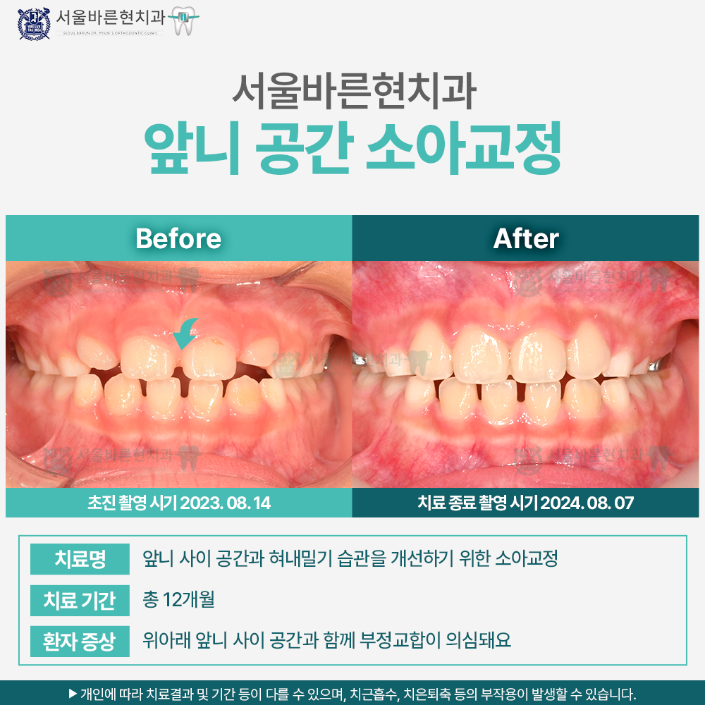 부산마린시티소아교정