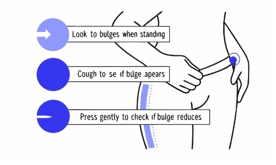 탈장 원인과 의심증상 확인하는 방법