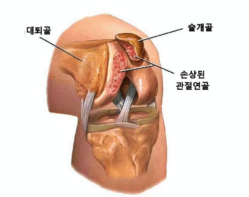슬개골-통증-증후군