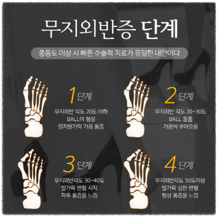 무지외반증 증상