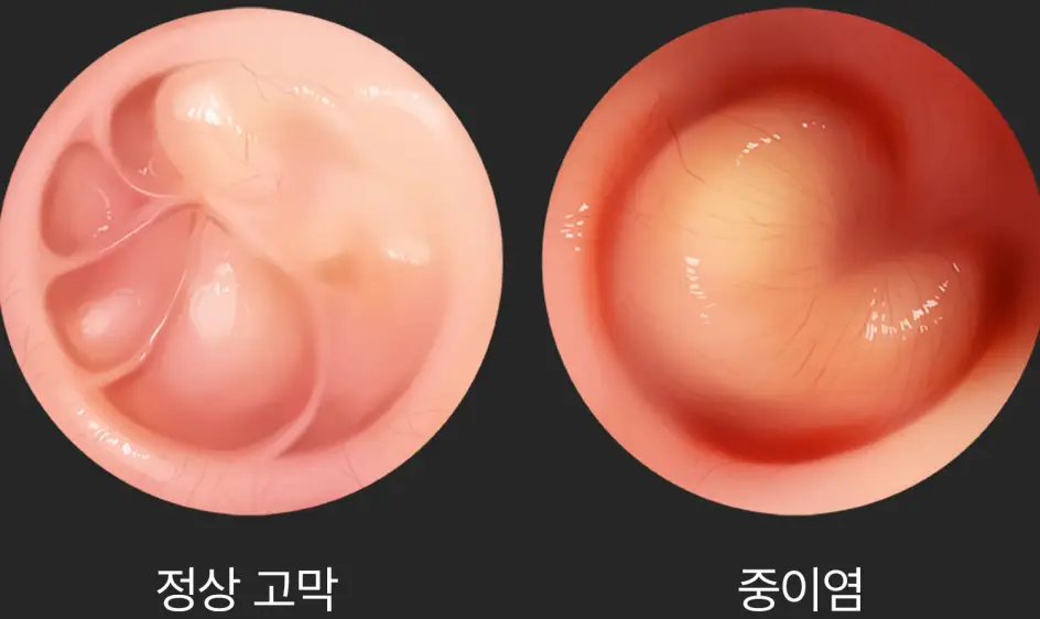 중이염 증상&amp;#44;원인&amp;#44;치료
