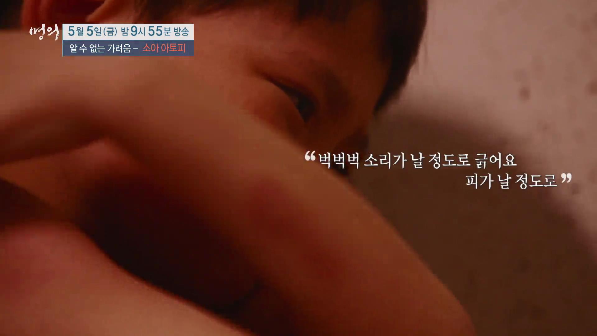 명의 어린이 소아 아토피 피부염 스테로이드 효과 및 부작용 완치 치료제 신약 비용 방법