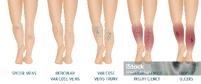 하지정맥류