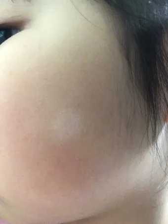 얼굴 버짐 증상 없애는 실전 방법 5가지 및 관리요령_23