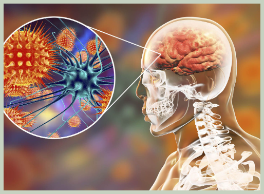 뇌수막염 원인 증상