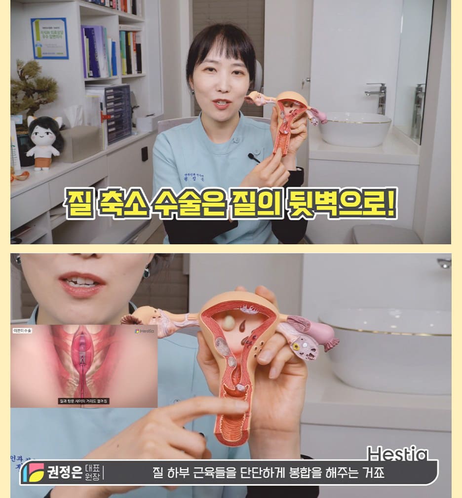 질축소성형 수술 방법은 어떻게 진행되죠?