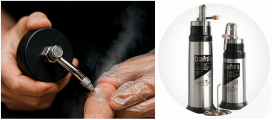 사마귀-냉동-치료