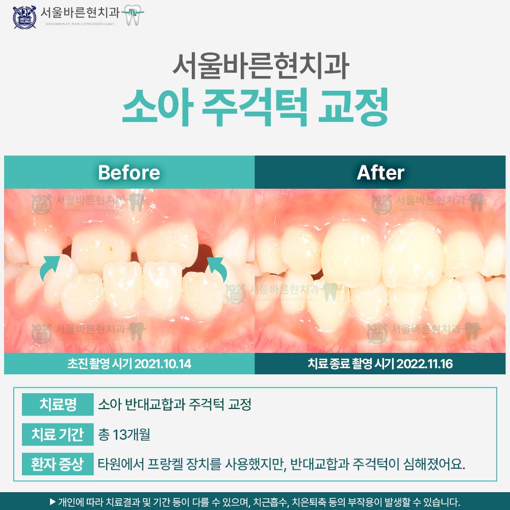 해운대치아교정