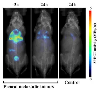 폐에 물이 차는 원인 증상 물참 관리 포인트에 대한 건강정보_14