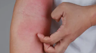 피부 붉은반점 17