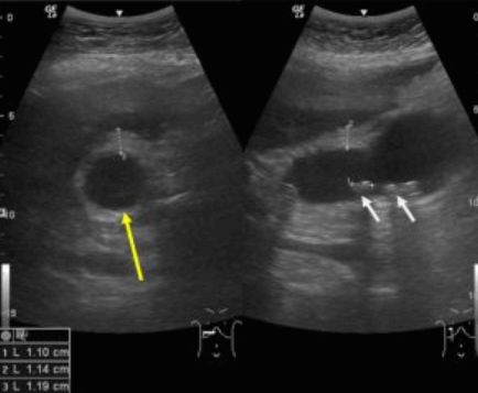 Empyema of the GB (담낭 축농증)