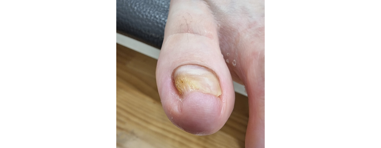 남양주시 내성발톱