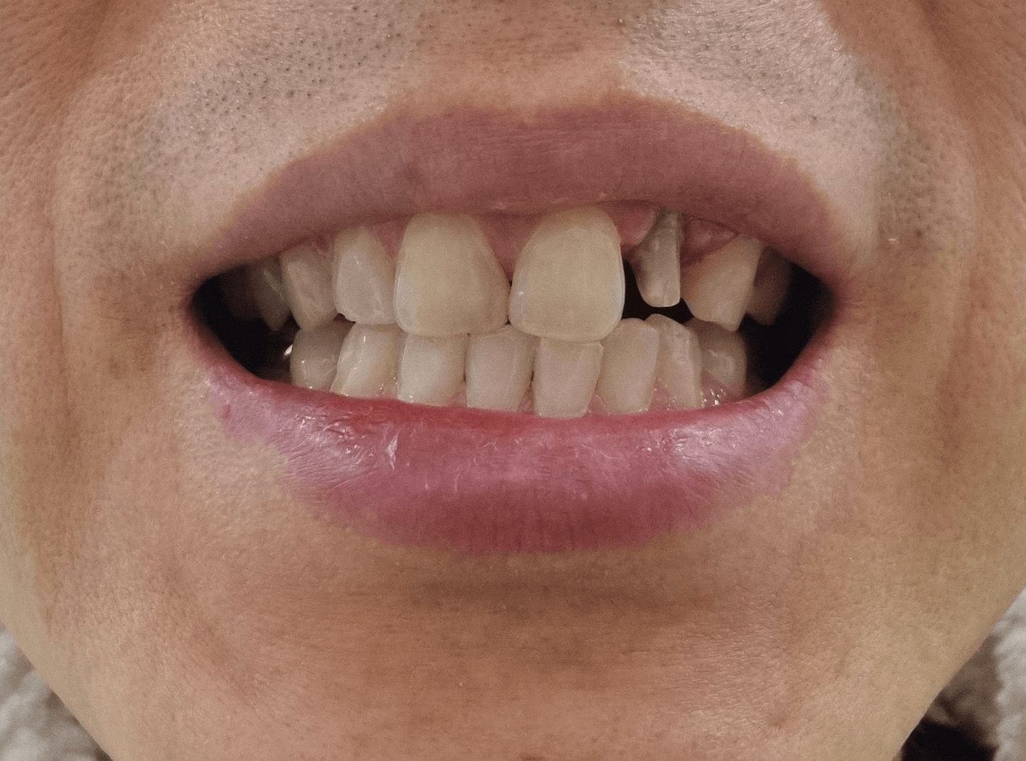 앞니 지르코니아