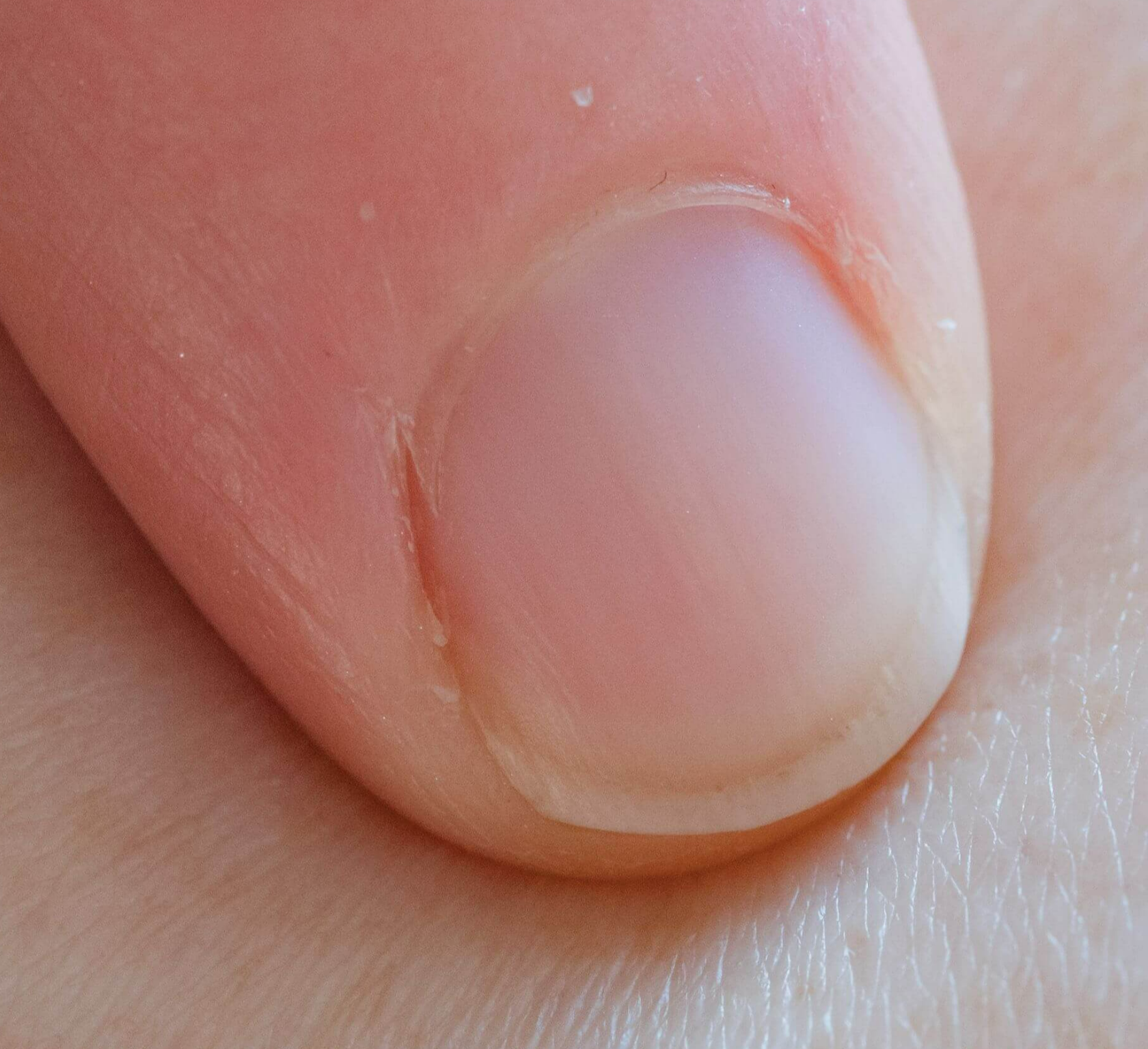 손톱에 세로줄이 생겼다면?