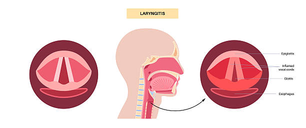 소리를 많이 사용하는 직업군은 후두에 자극이 지속적으로 가해져 후두암 발병 위험이 증가